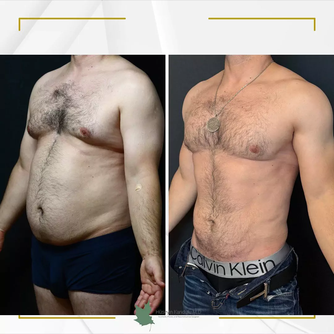 liposuction in dubai