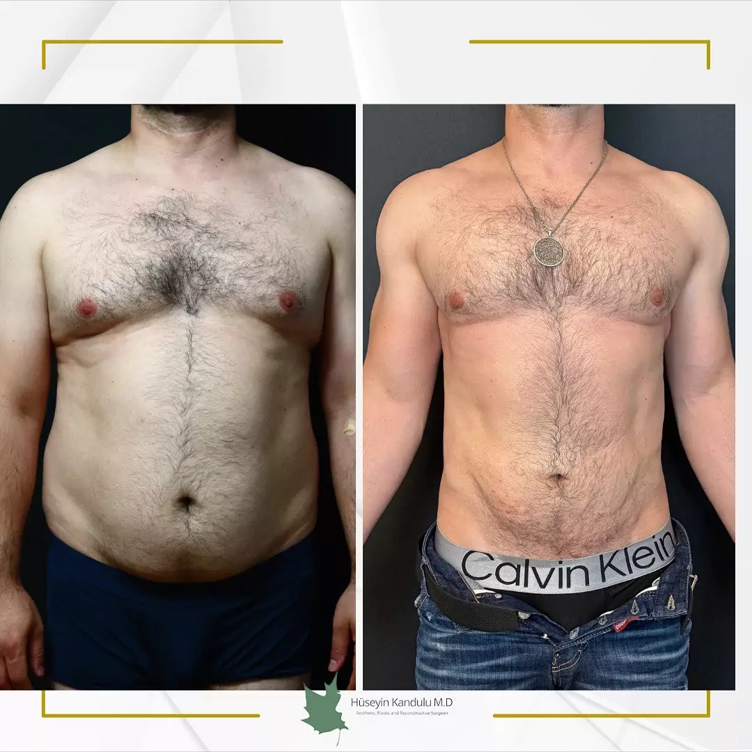 Liposuction in Turkey