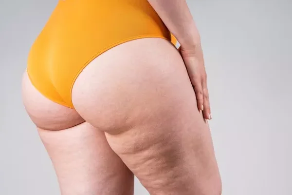 Lipedema Turkey