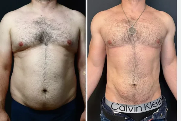 Liposuction in Dubai