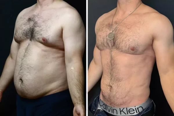 Liposuction in Turkey