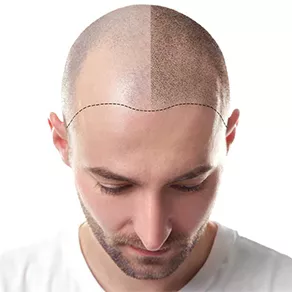 Hair Transplant Turkey