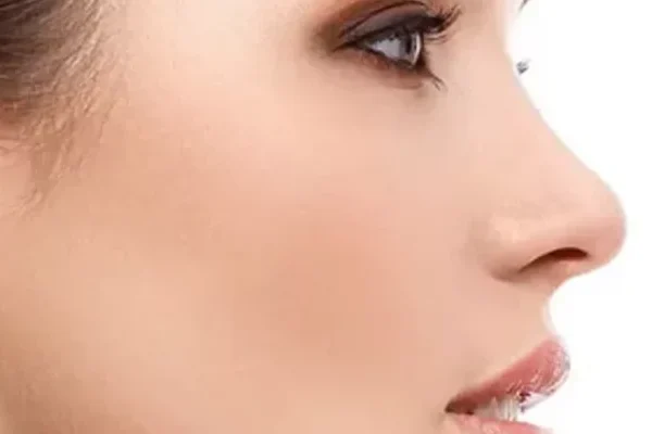Secondary Rhinoplasty