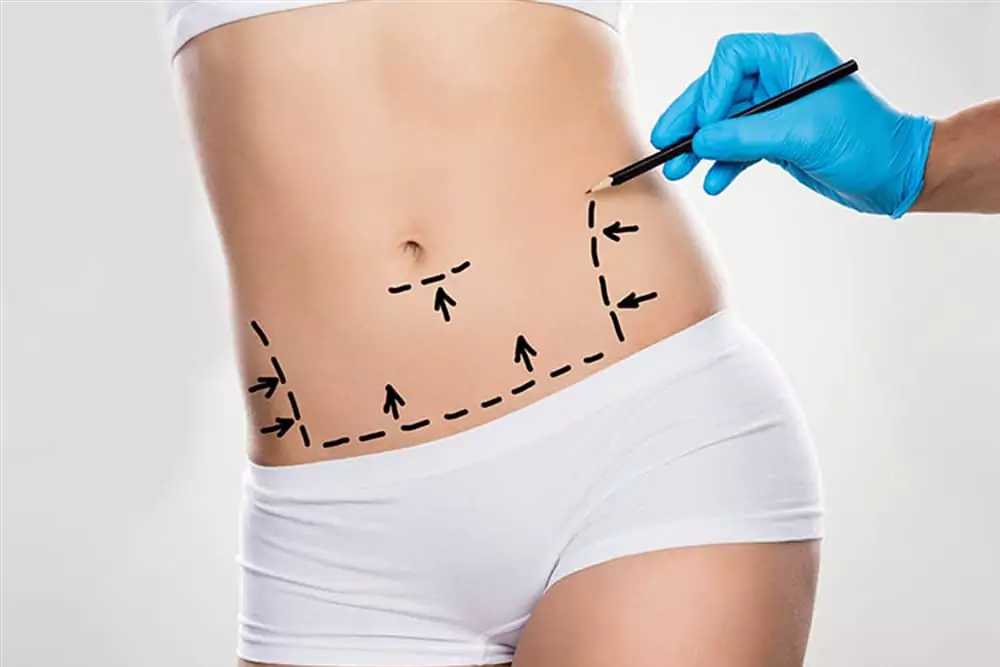 Vaser Liposuction Turkey