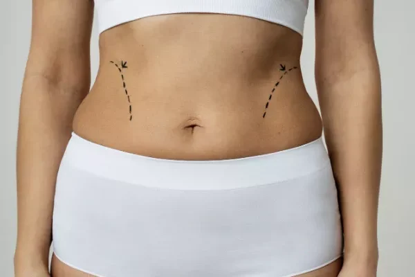 Belt Lipectomy Turkey